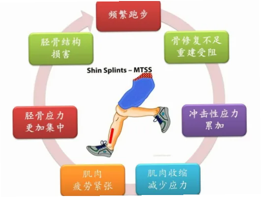 跑步胫骨应力综合征是许多跑者常遇到的问题
